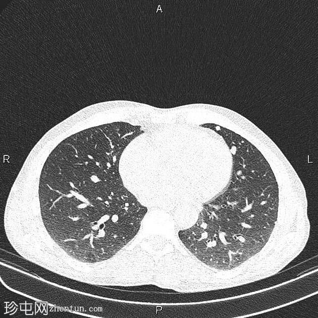 转移性直肠腺癌