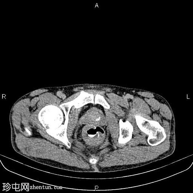 转移性直肠腺癌