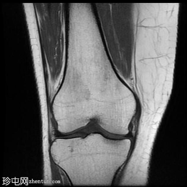 四头肌腱腱鞘囊肿(MRI)