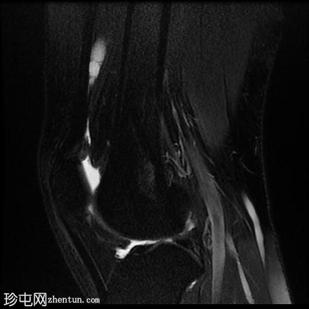 四头肌腱腱鞘囊肿(MRI)