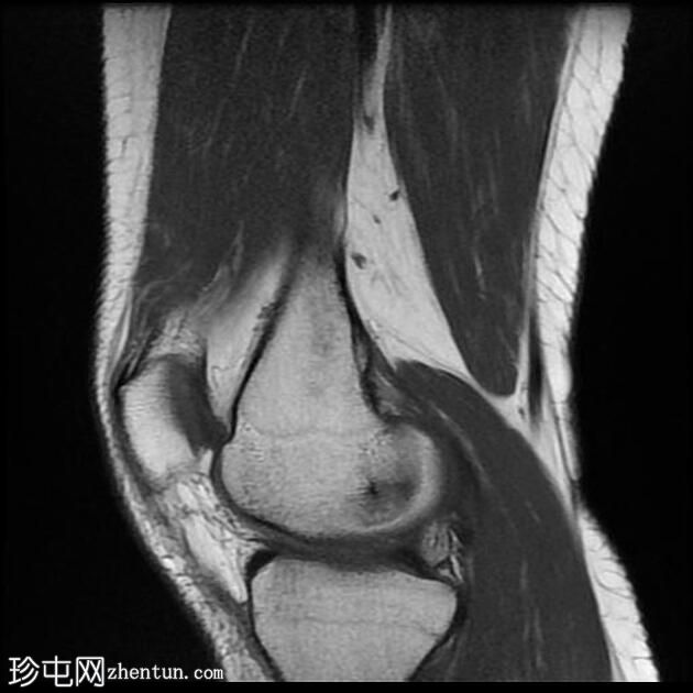 四头肌腱腱鞘囊肿(MRI)