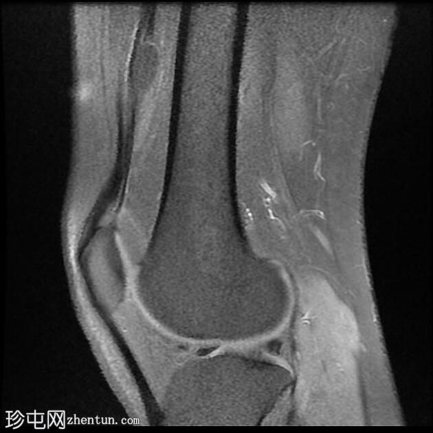 四头肌腱腱鞘囊肿(MRI)