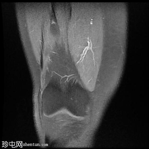 四头肌腱腱鞘囊肿(MRI)