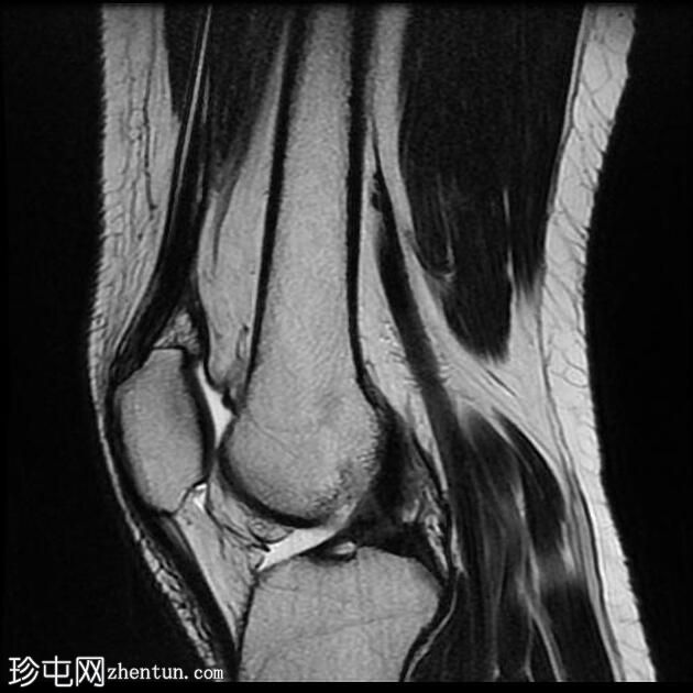 四头肌腱腱鞘囊肿(MRI)