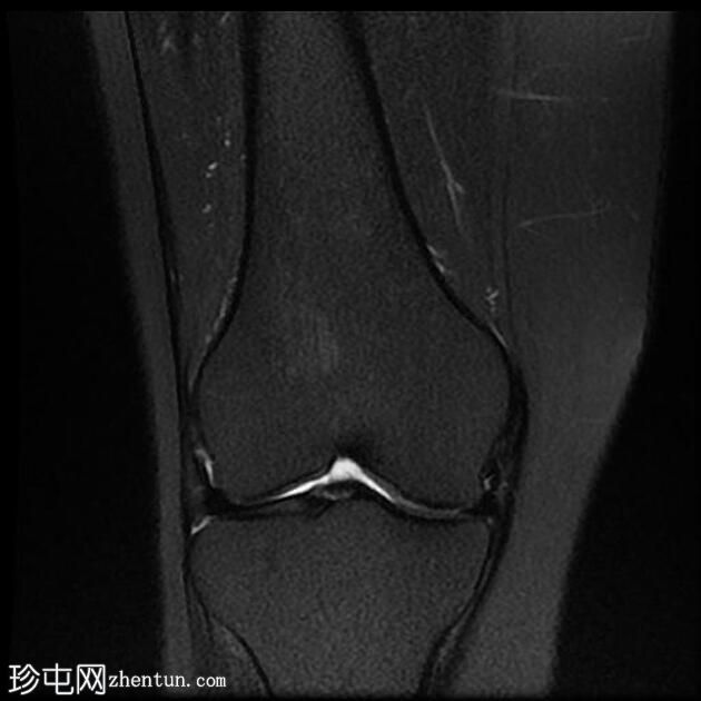 四头肌腱腱鞘囊肿(MRI)