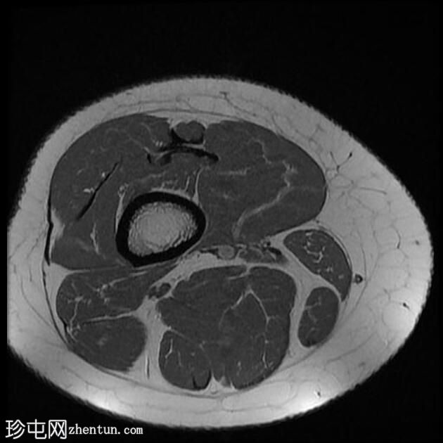 四头肌腱腱鞘囊肿(MRI)