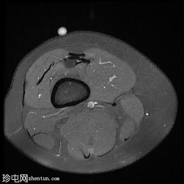 四头肌腱腱鞘囊肿(MRI)