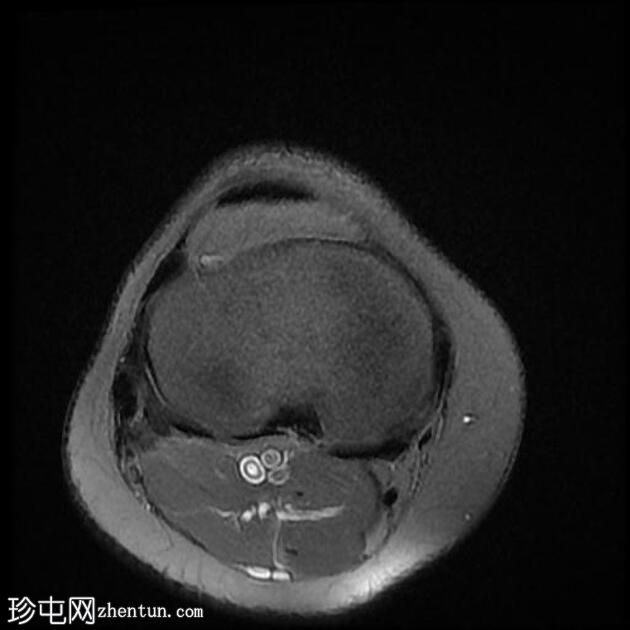 四头肌腱腱鞘囊肿(MRI)