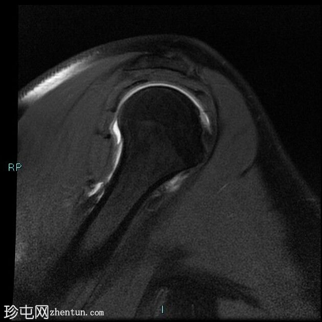 盂肱韧带后带的肱骨撕脱