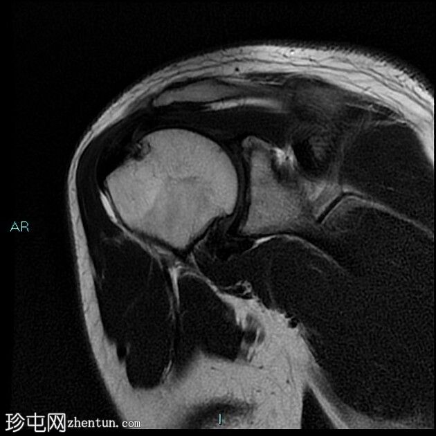 盂肱韧带后带的肱骨撕脱