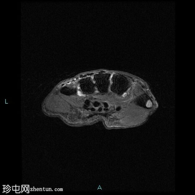 骨膜软骨瘤