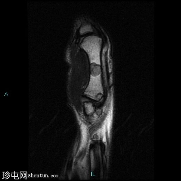 骨膜软骨瘤