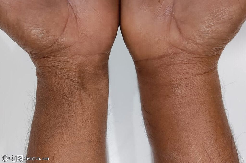 尺侧腕屈肌——钙化性肌腱炎