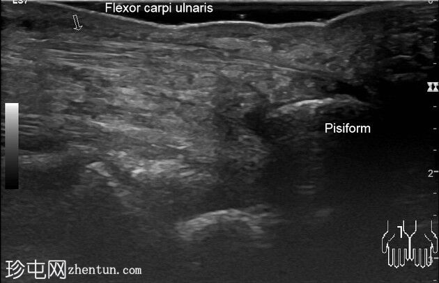 尺侧腕屈肌——钙化性肌腱炎