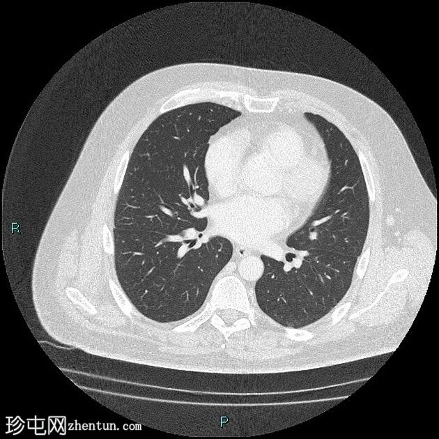 转移性软骨肉瘤