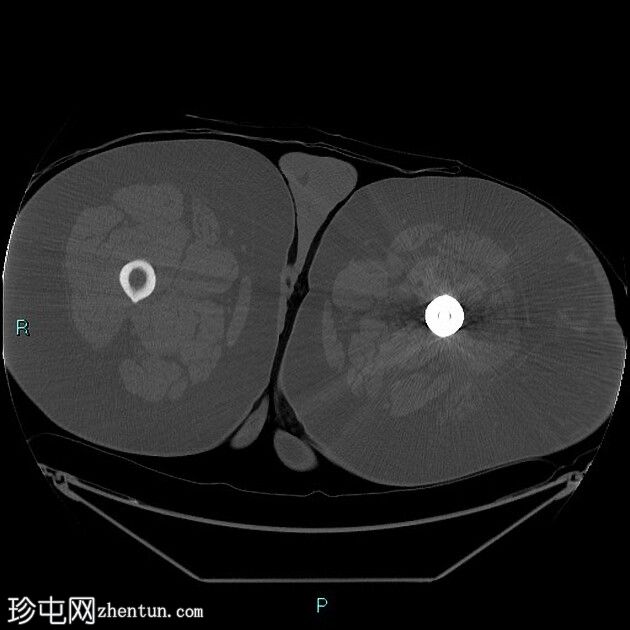 转移性软骨肉瘤