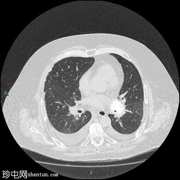 转移性软骨肉瘤