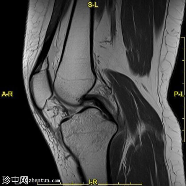 胫骨平台骨折:Schatzker V型