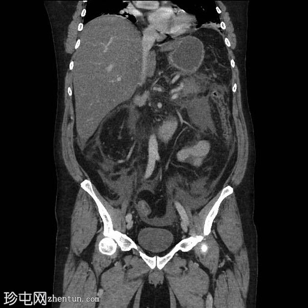 胰腺炎引起的结肠截断征