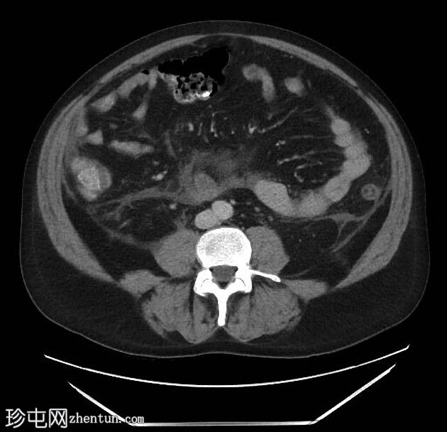 胰腺炎引起的结肠截断征