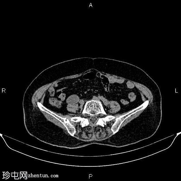 阑尾粘液囊肿