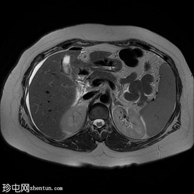 腹腔镜胆管损伤所致胆道腹膜炎