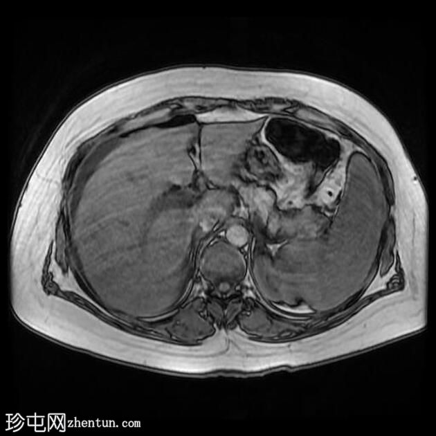 腹腔镜胆管损伤所致胆道腹膜炎