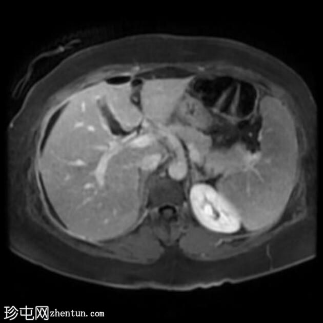 腹腔镜胆管损伤所致胆道腹膜炎