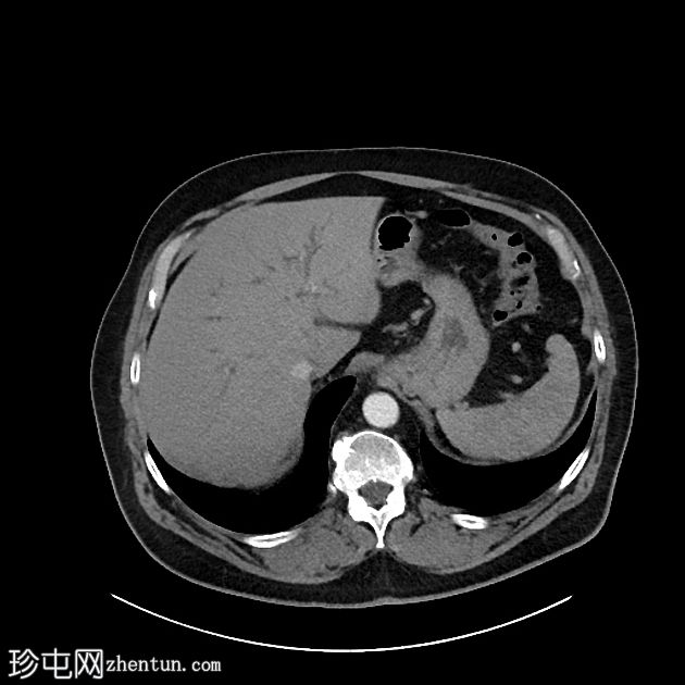 IgG4相关的自身免疫性胆管炎、胰腺炎和假瘤