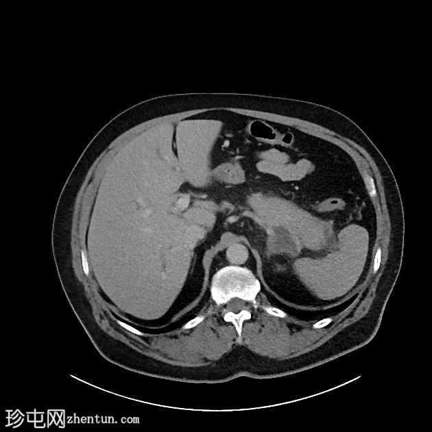 IgG4相关的自身免疫性胆管炎、胰腺炎和假瘤