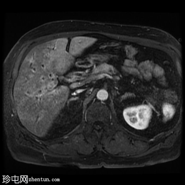 IgG4相关的自身免疫性胆管炎、胰腺炎和假瘤