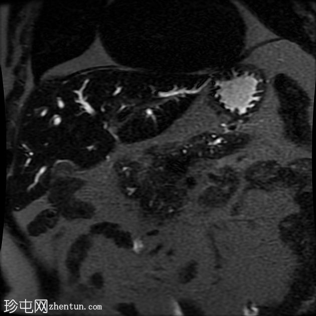 IgG4相关的自身免疫性胆管炎、胰腺炎和假瘤