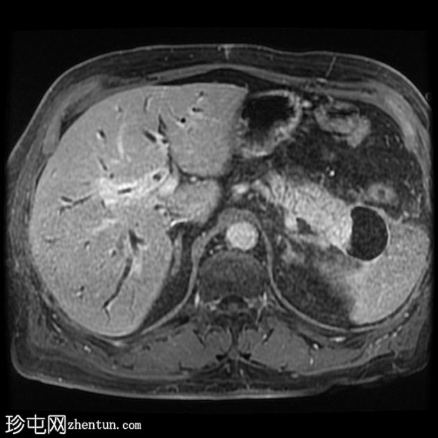 IgG4相关的自身免疫性胆管炎、胰腺炎和假瘤