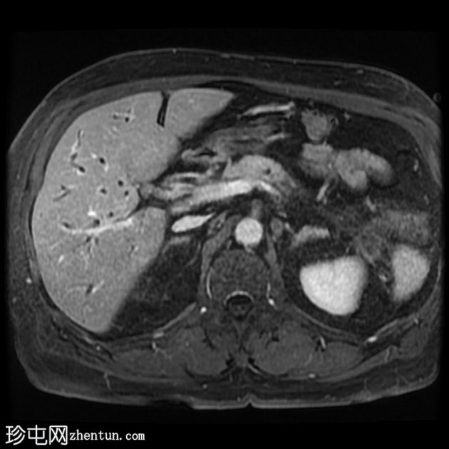 IgG4相关的自身免疫性胆管炎、胰腺炎和假瘤