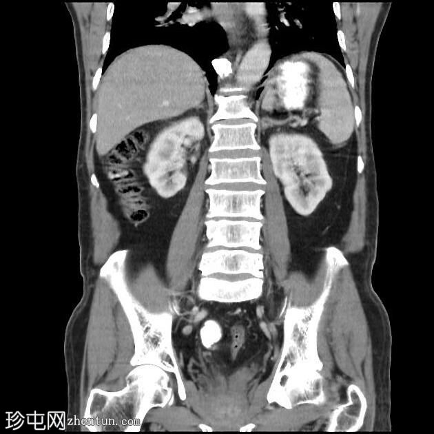 急性胆囊炎