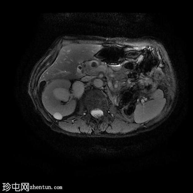 胆石症和胆总管结石