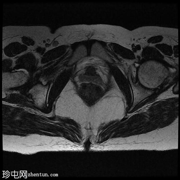 经括约肌肛周瘘