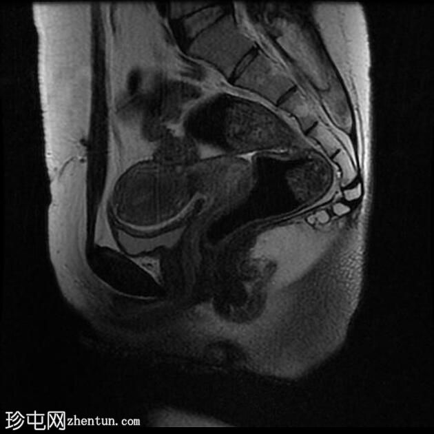 经括约肌肛周瘘