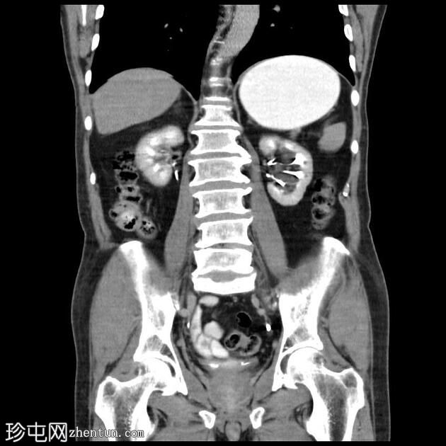 胃窦幽门腺癌