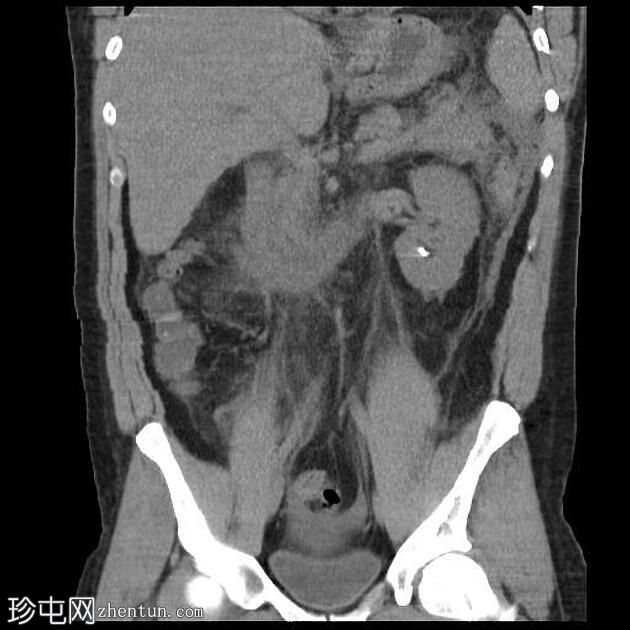 急性胰腺炎