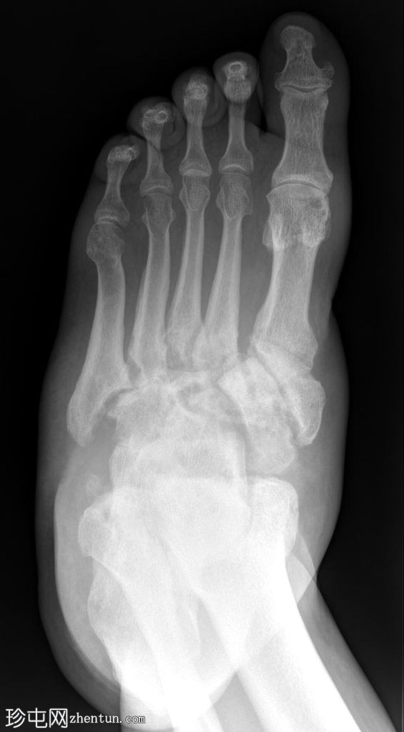 足部 Charcot 神经关节病