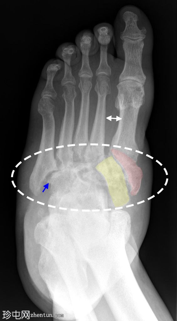 足部 Charcot 神经关节病