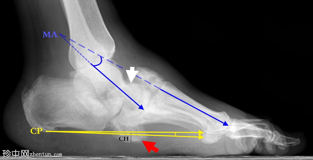 足部 Charcot 神经关节病