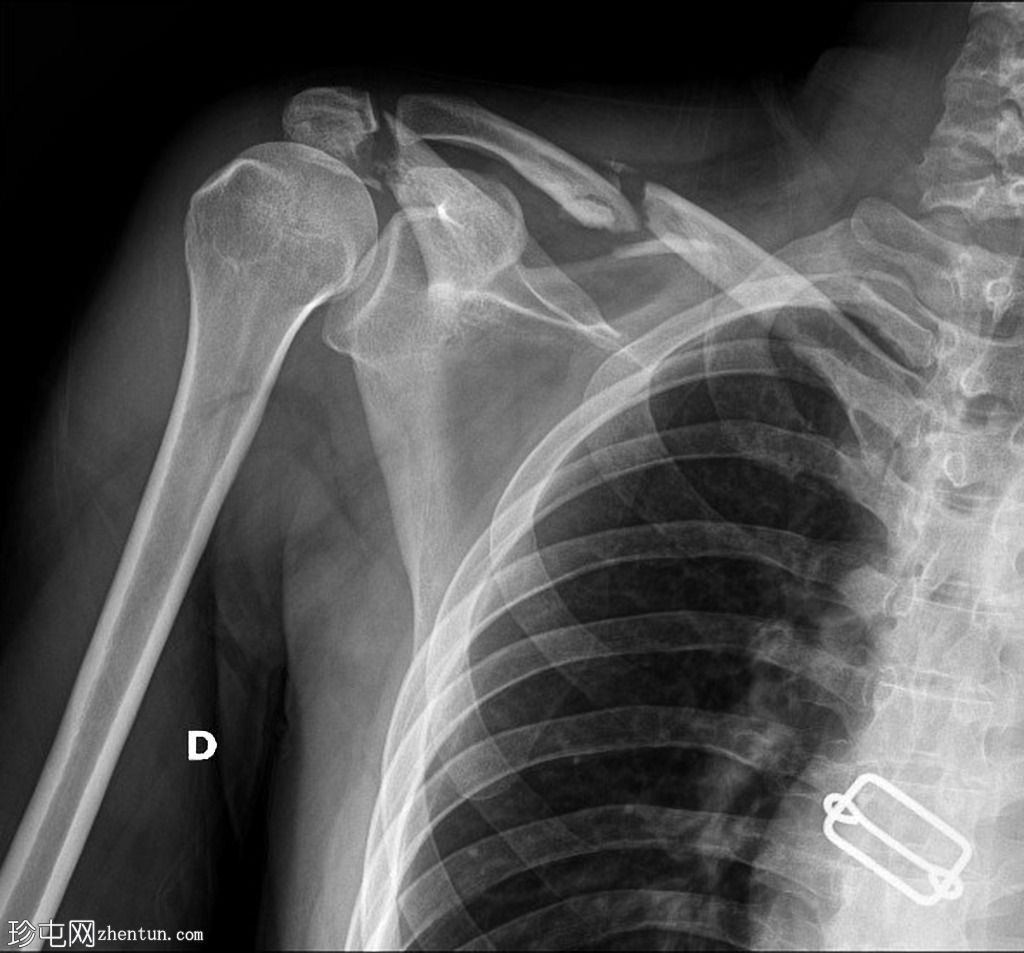 肩峰和锁骨骨折