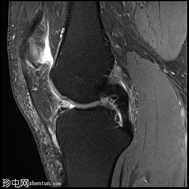 ACL 和内侧半月板撕裂