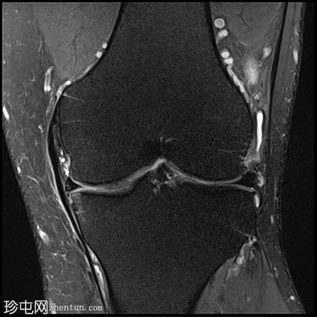 ACL 和内侧半月板撕裂