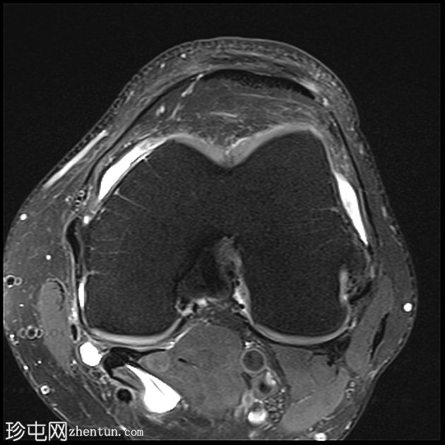 ACL 和内侧半月板撕裂