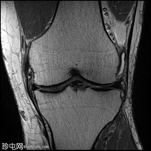 ACL 和内侧半月板撕裂