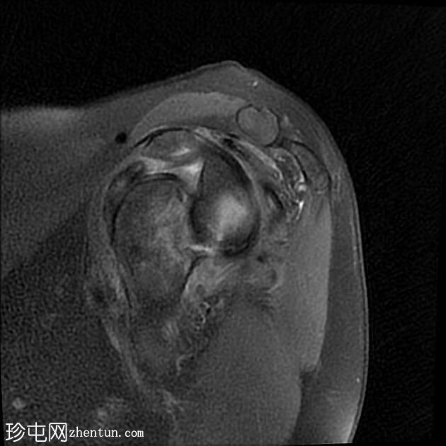 肩关节前脱位伴 Hill-Sachs 缺损和骨性 Bankart 损伤