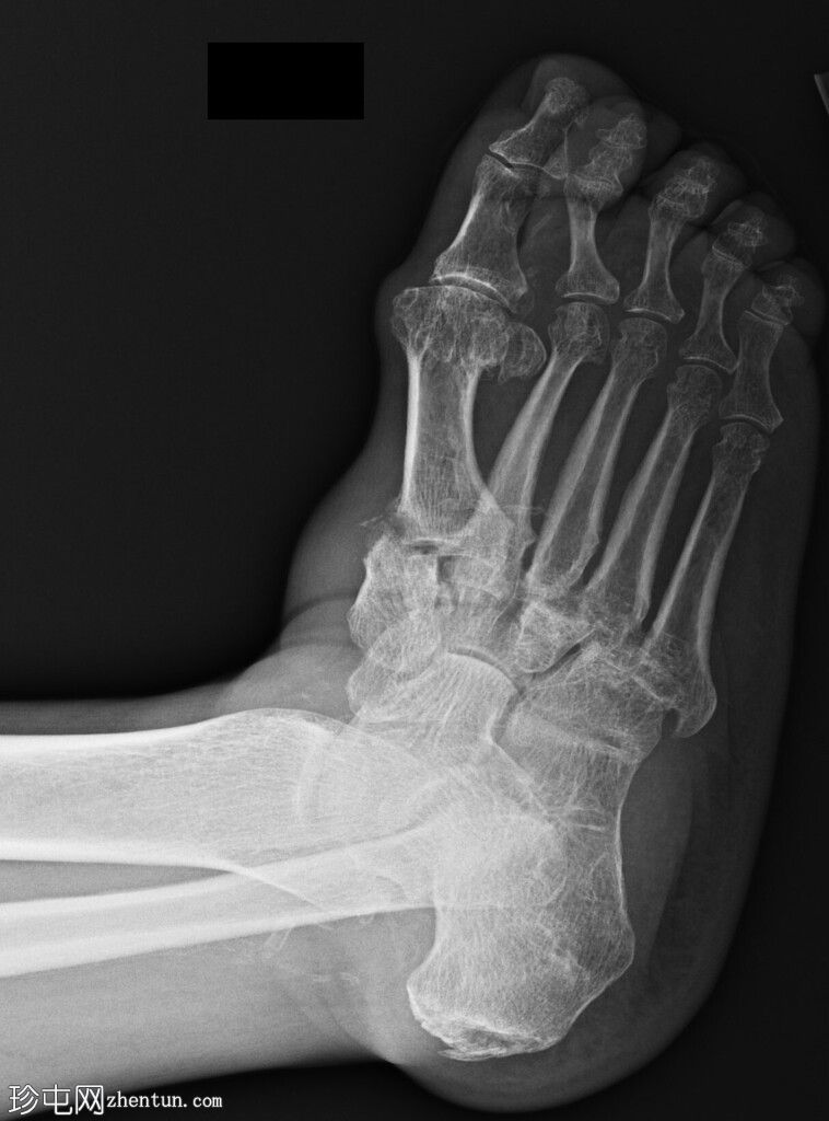 Charcot 足 - 同侧 Lisfranc 脱位